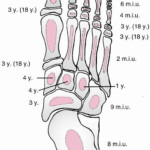 Fractures And Dislocations Of The Foot TeachMe Orthopedics